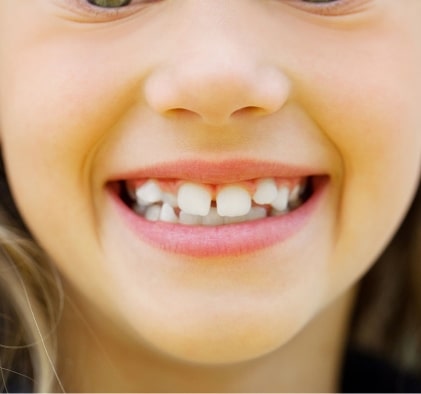 Preventive Dental Treatments for kids and teens