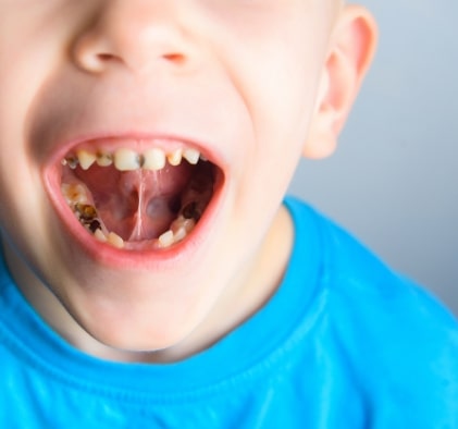 Restorative Dental Treatments for kids and teens